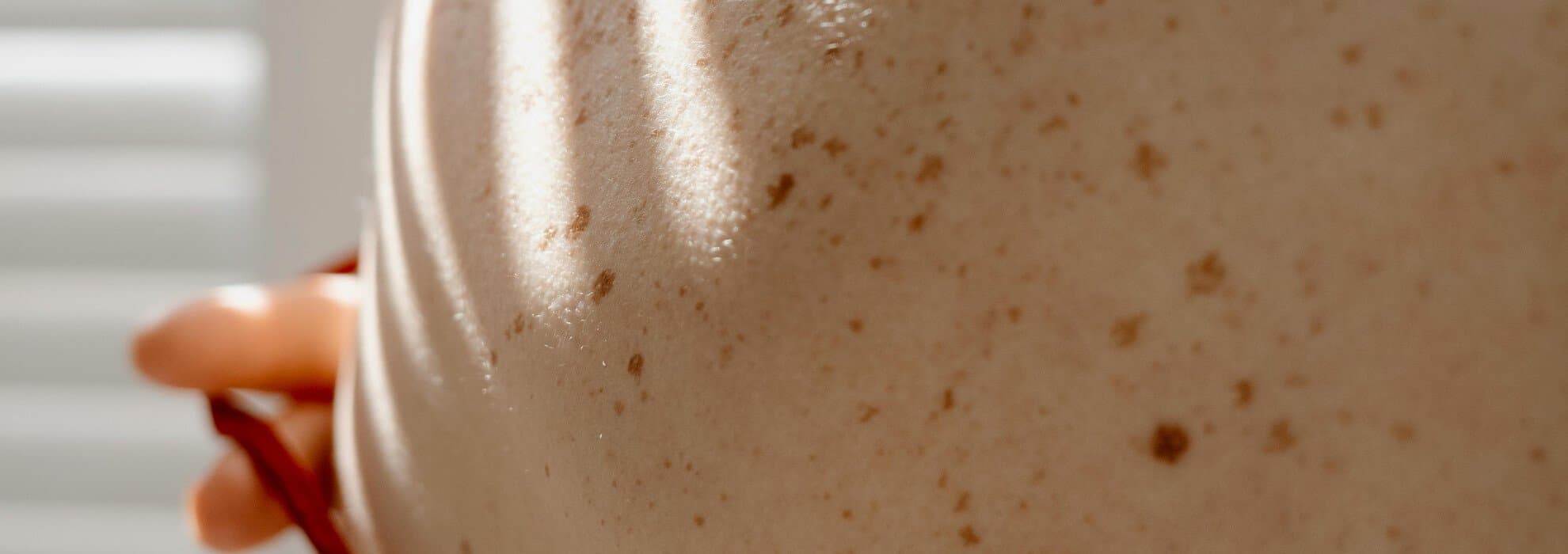 Kvinnas rygg med födelsemärken